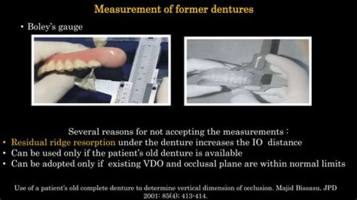 A Journey Towards Denture Success