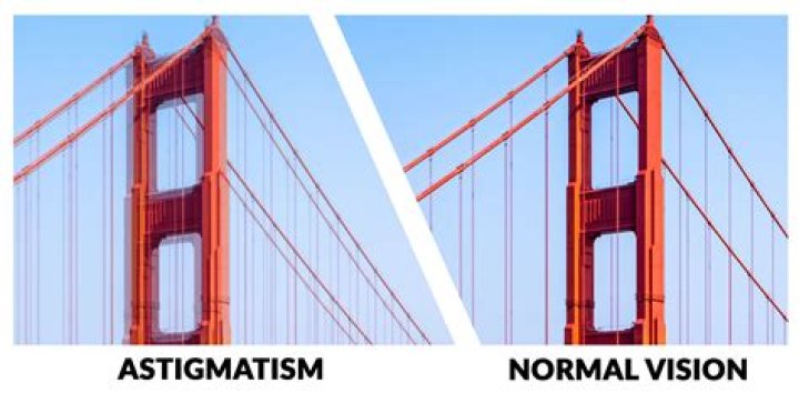 Astigmatism Pictures Reveal Vision Breakthroughs