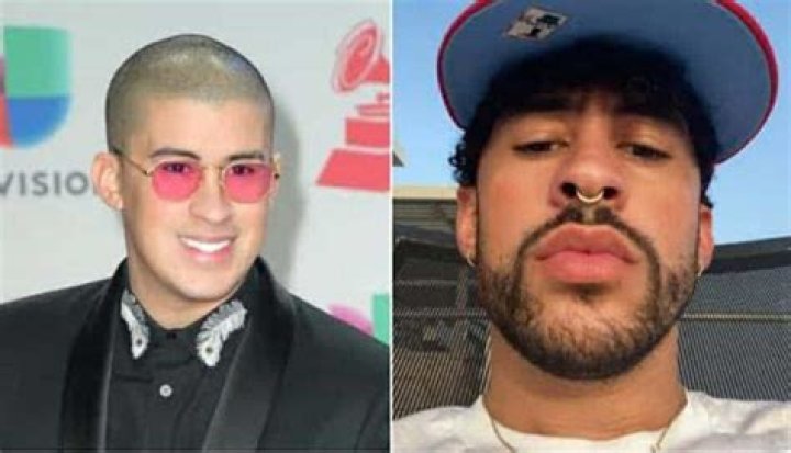Bad Bunny Before Jaw Surgery: What Happened To His Jaw?
