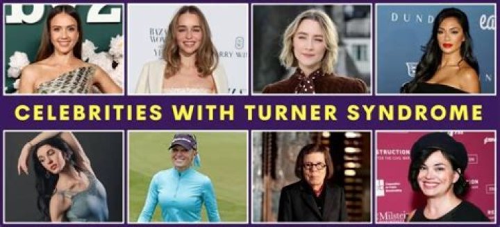 Celebrities With Turner Syndrome: Unlocking Discoveries And Insights