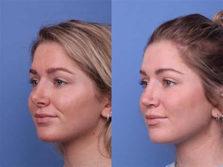 Did Go Yoon Jung Get Her Nose Done? Plastic Surgery Before And After Photos