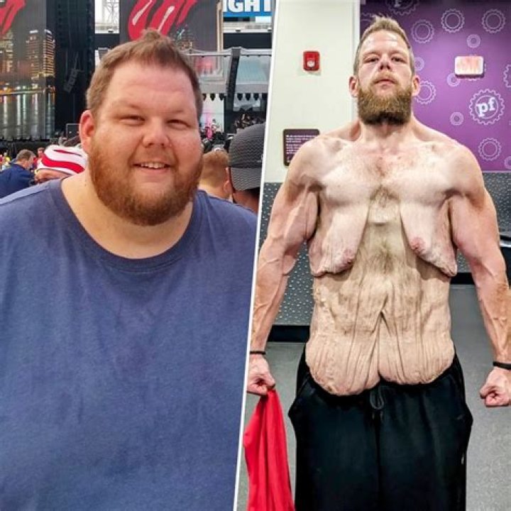 Discoveries Before Weight Loss Surgery