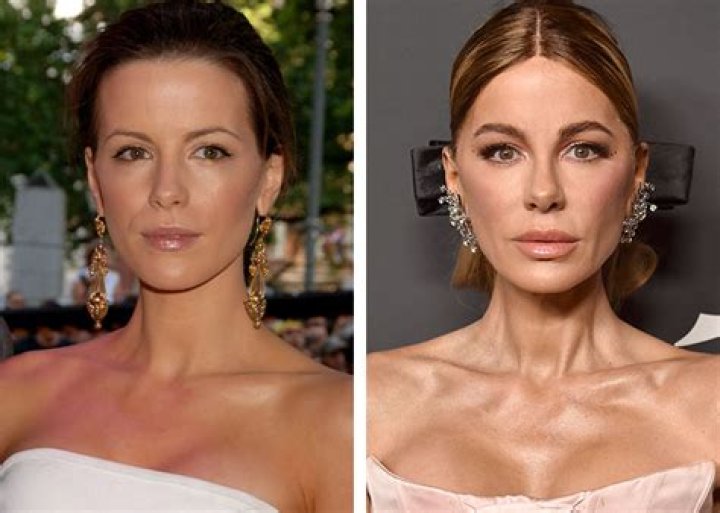 Kate Fleetwood's Plastic Surgery Journey