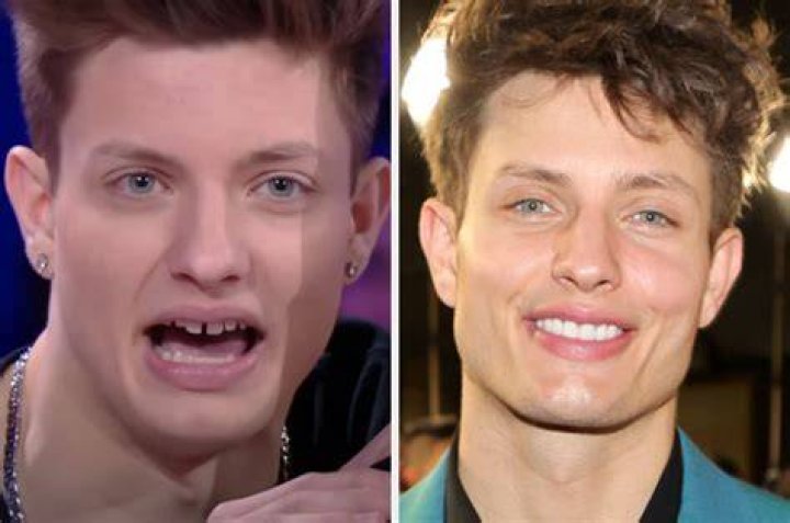 Matt Rife Before Dental