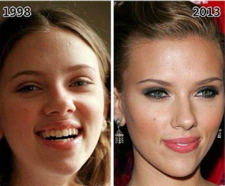 Scarlett Johansson's Plastic Surgery: Uncovering The Truth