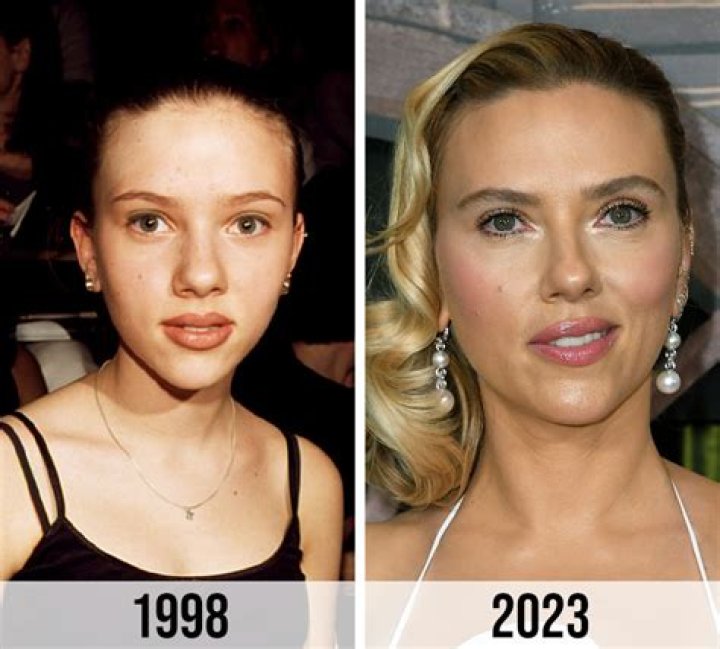 Scarlett Johansson Breast Reduction Plastic Surgery Before and After