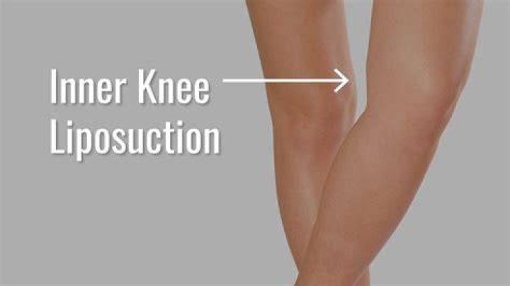 Uncover The Startling Truth About Botched Knee Liposuction