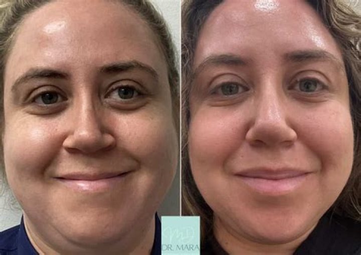 Unlock The Secrets Of "Jelly Roll Botox": Before And After Revelations