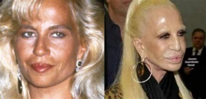 Unveiling Donatella Versace's Plastic Surgery Journey: Discoveries And Insights