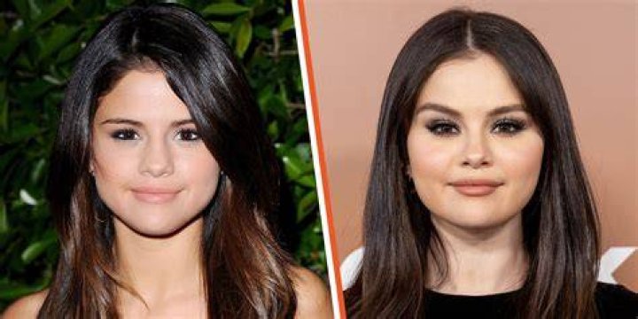 Unveiling Selena Gomez's Plastic Surgery Journey: Surprising Truths Revealed