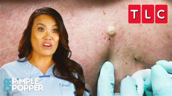 Unveiling The Genius Behind Dr. Pimple Popper: Meet Dr. Jeffrey Rebish