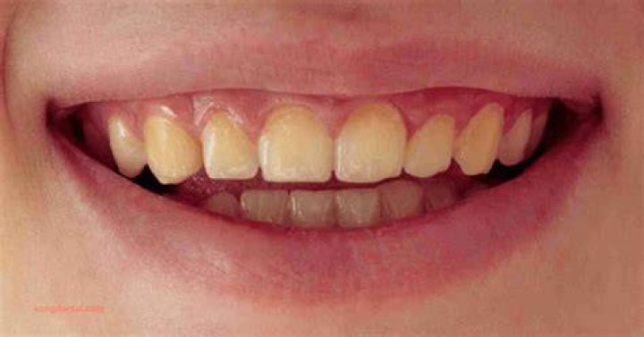 Why do swimmers have yellow teeth? |